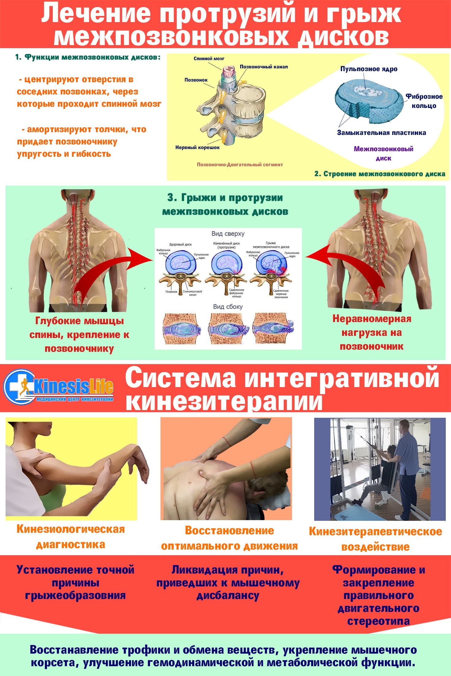 Грыжа межпозвоночного диска